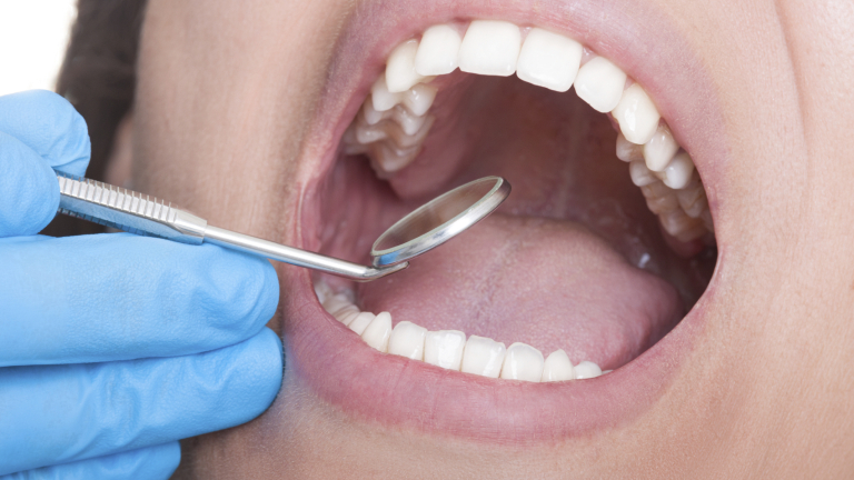 Dentist inspecting perfect teeth using mirror